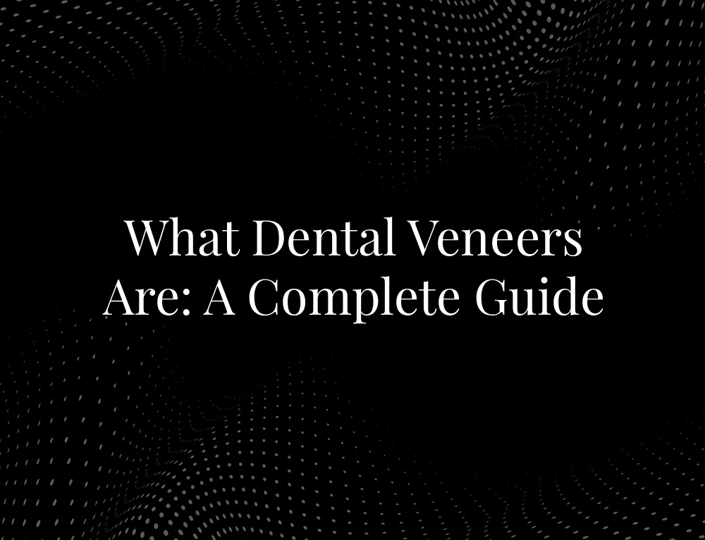 What Dental Veneers Are: A Complete Guide