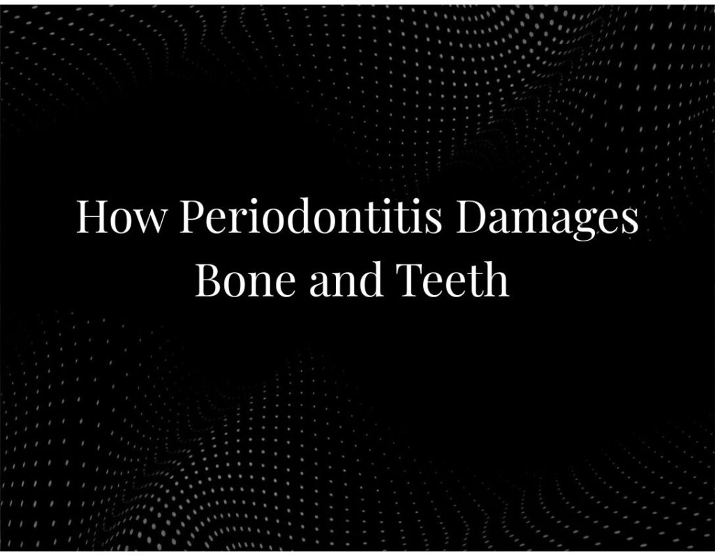 Periodontitis bone teeth damage diagram
