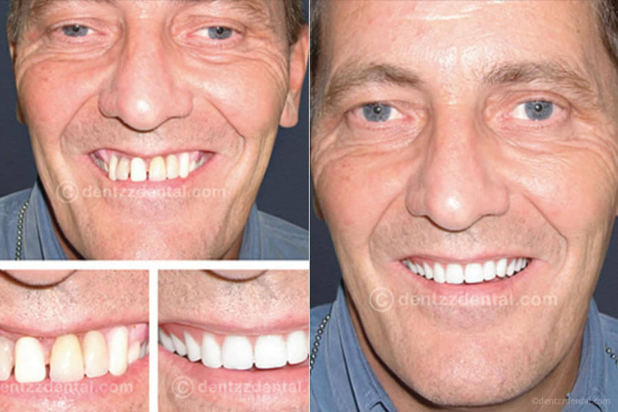 A Full Mouth Implant Case Performed By Our team