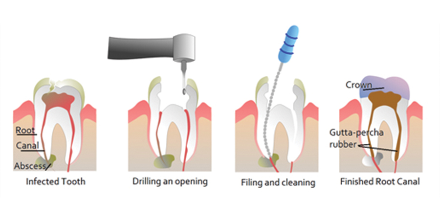 Root Canal Treatments Root Canal Treatments