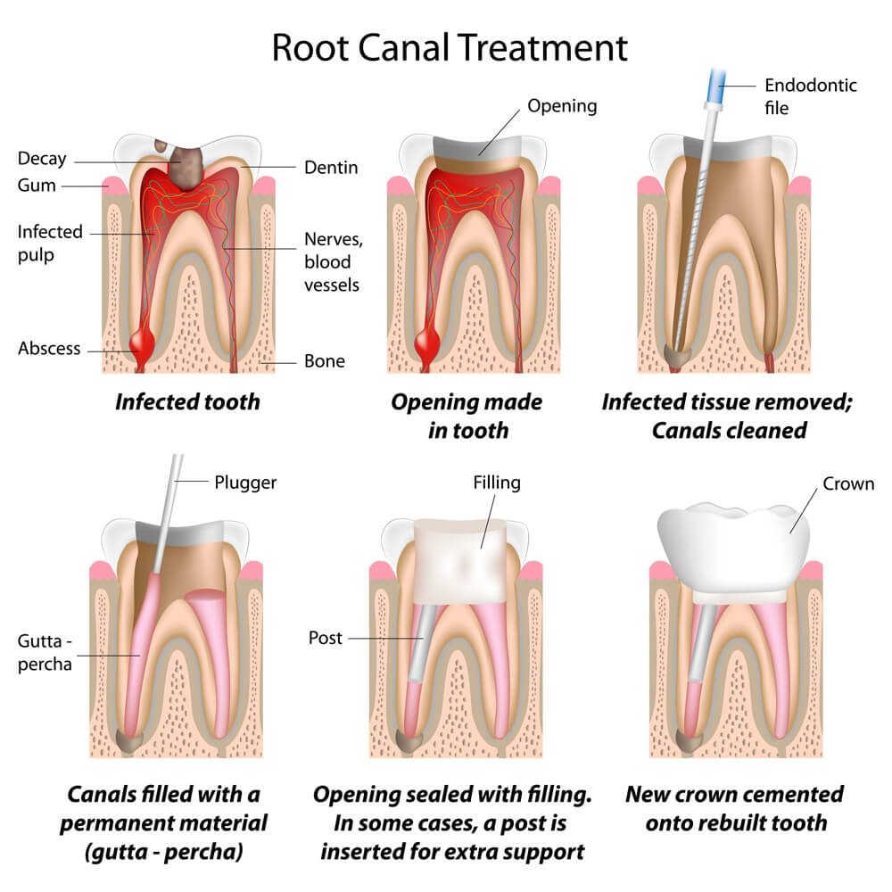 Overview Of Root Canal Treatments