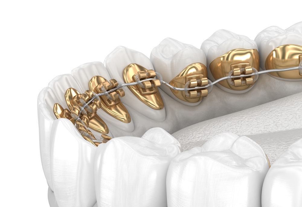 Lingual Braces Lingual Braces