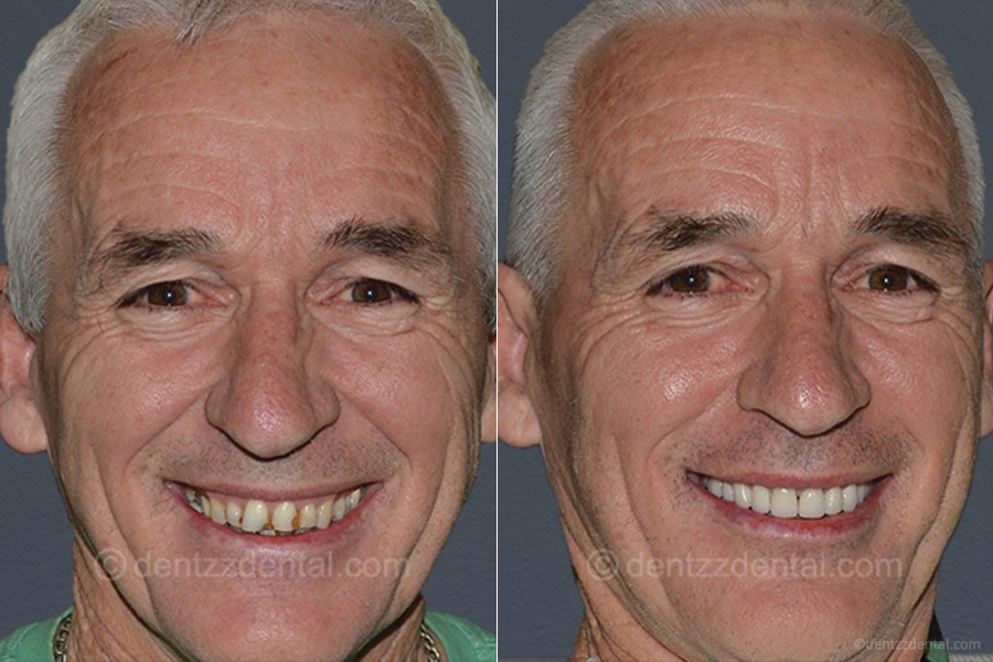 A Few Full Mouth Reconstruction and Implant Cases Performed By Our Team