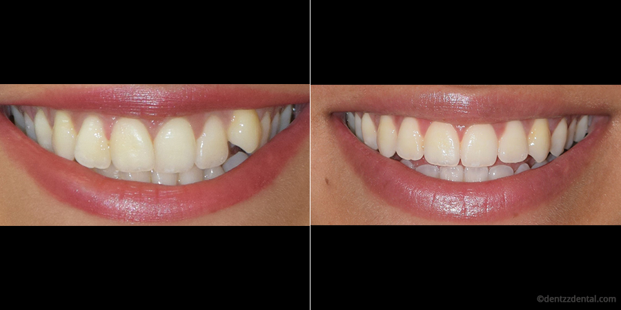 Invisible braces, Clear dental braces, Teeth braces