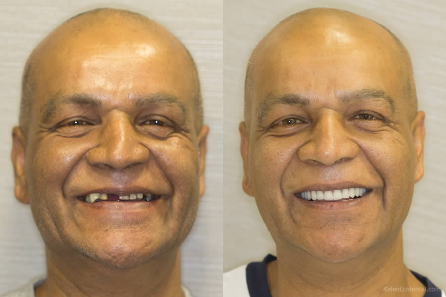 A Full Mouth Implant Case Performed By Our team