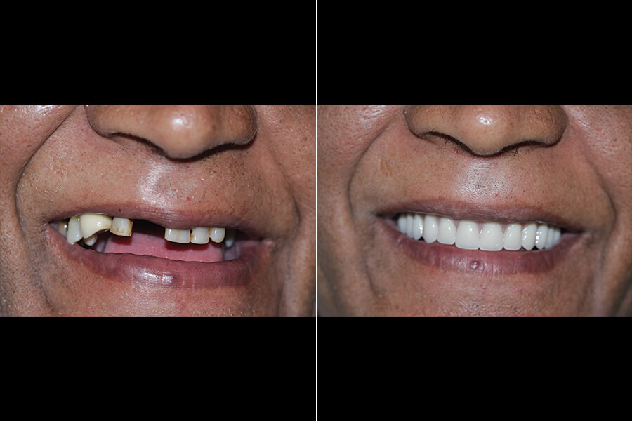 Full Mouth Reconstruction