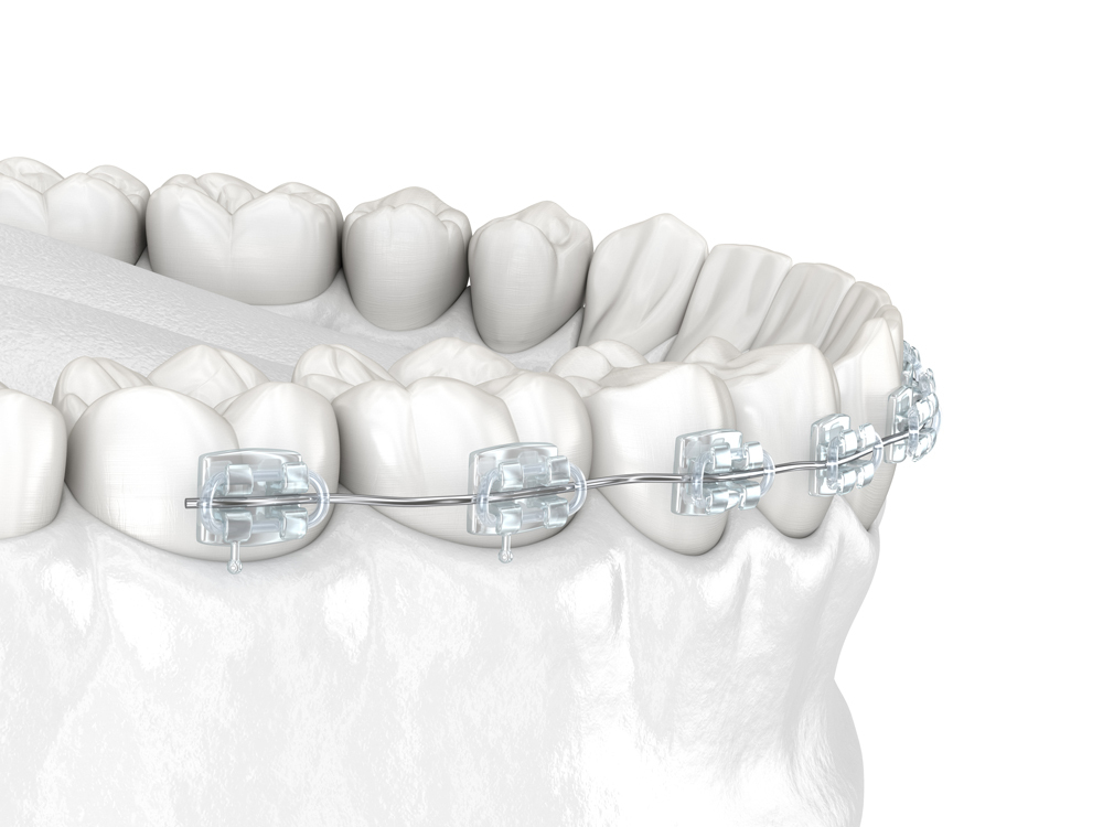 Ceramic Braces Ceramic Braces