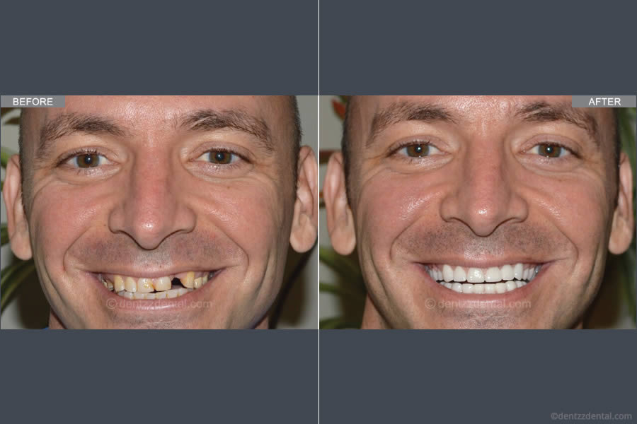 A Full Mouth Implant Case Performed By Our team