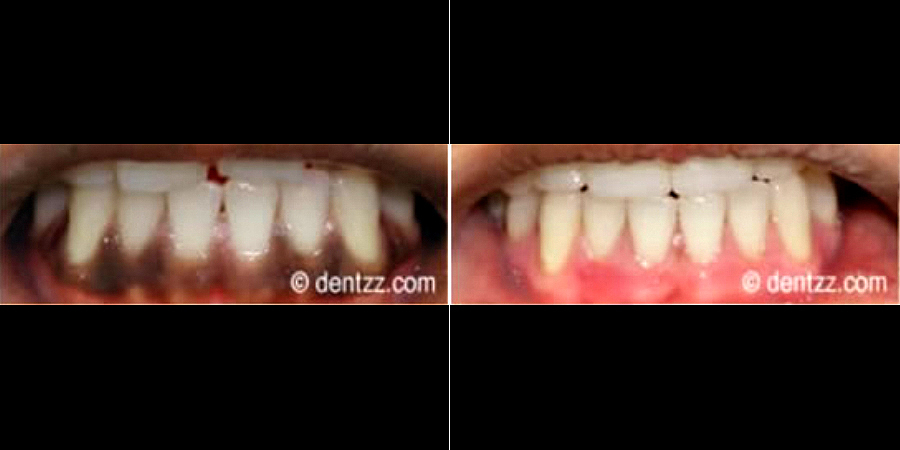 Depigmentation of Gums