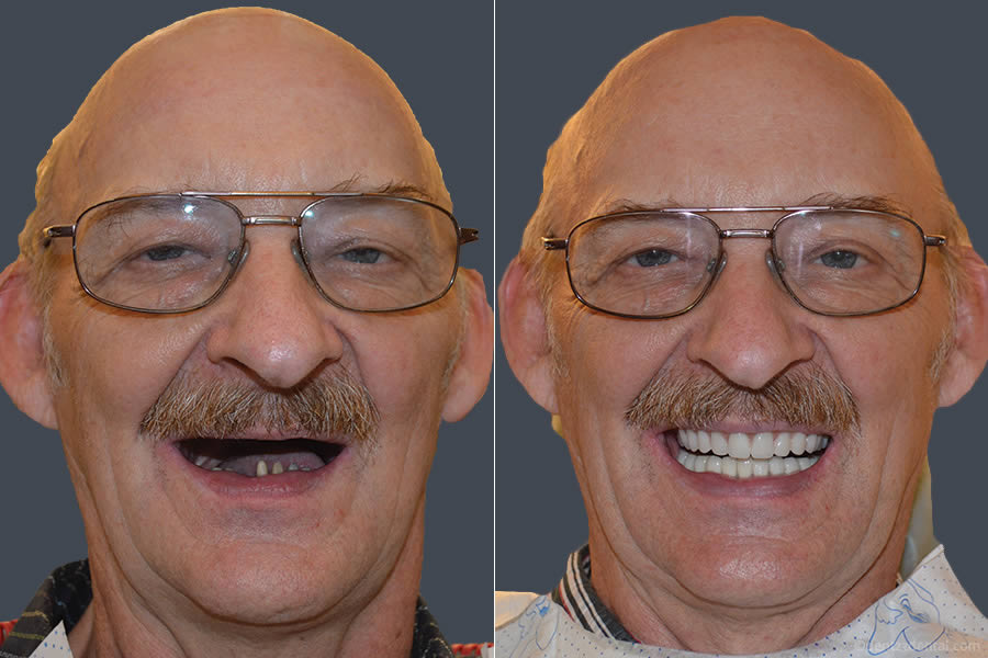 A Full Mouth Implant Case Performed By Our Team