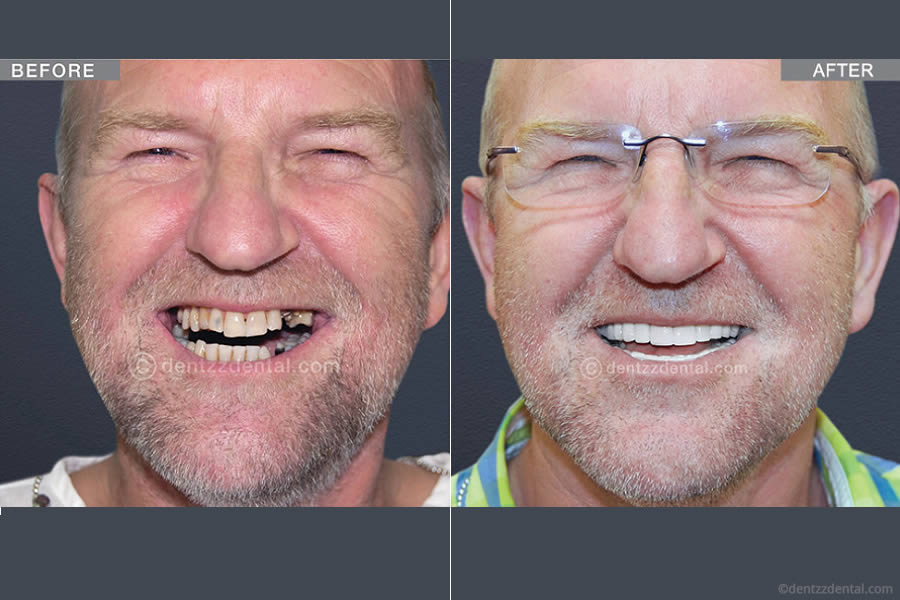 A Full Mouth Implant Case Performed By Our Team