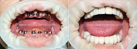 Aesthetics In Dental Implants