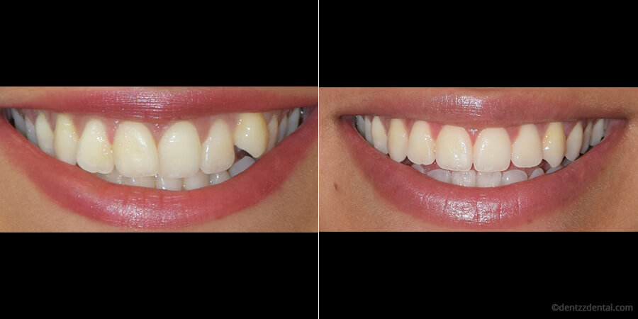 A Case Of Aligners Performed At Dentzz