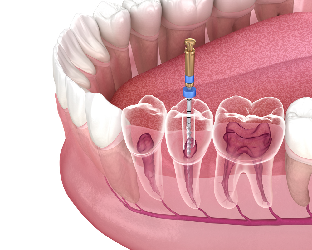 root-canal-treatment