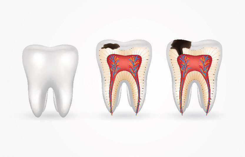root-canal