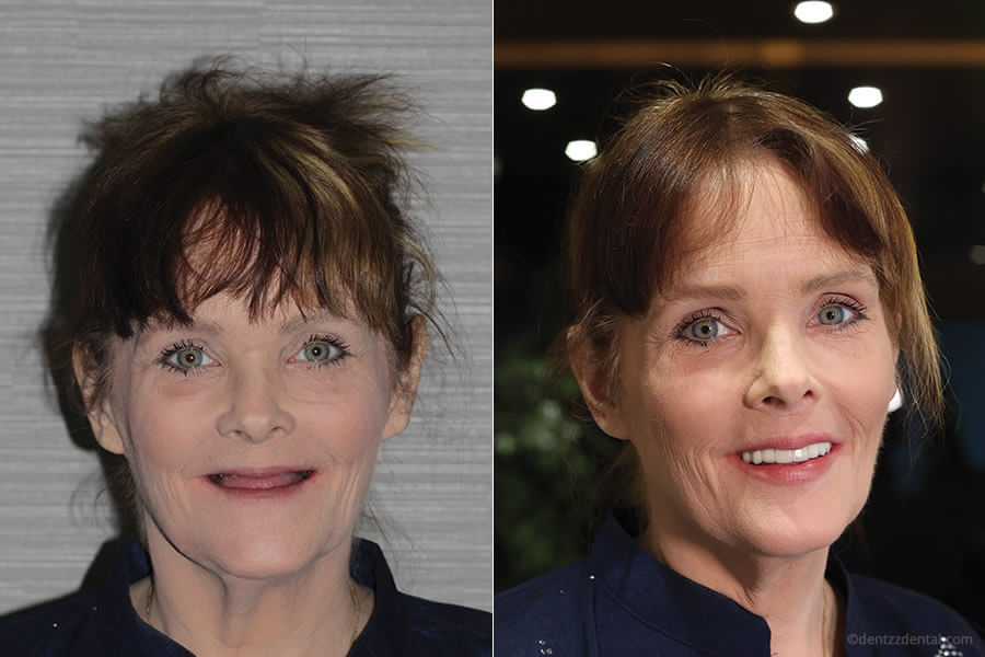 A Full Mouth Implant Case Performed By Our team A Full Mouth Implant Case Performed By Our team
