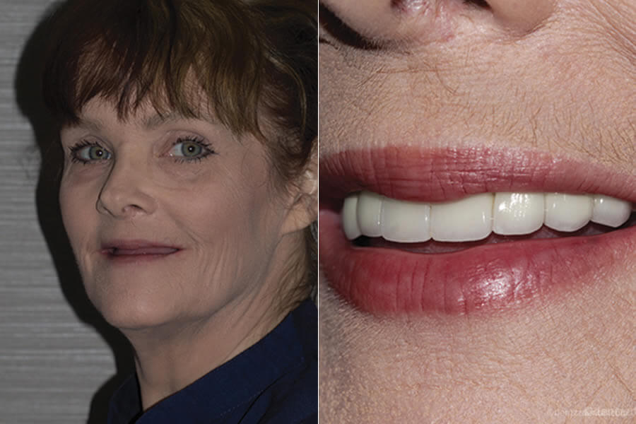 A Full Mouth Implant Case Performed By Our team A Full Mouth Implant Case Performed By Our team