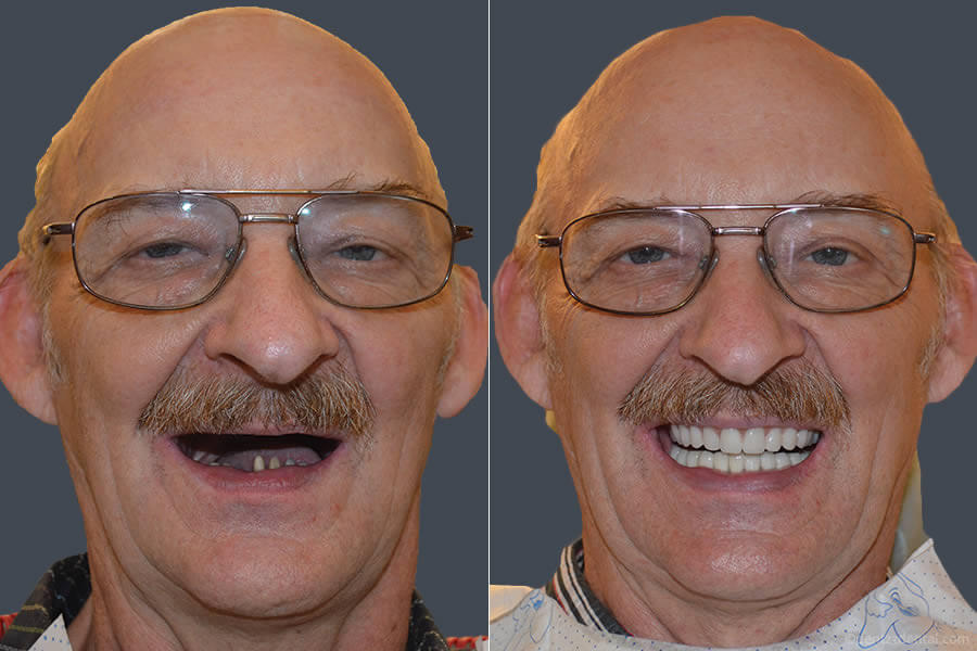 A Full Mouth Implant Case Performed By Our team
